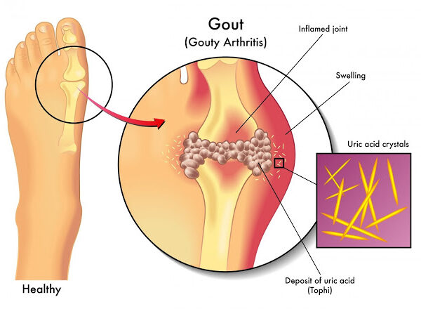 Resveratrol Rawat Gout Kaki ?