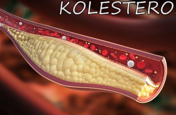 Set Kolesterol Shaklee Elak Masalah Kronik Berat Lain