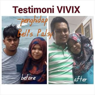 testimoni vivix bells palsy