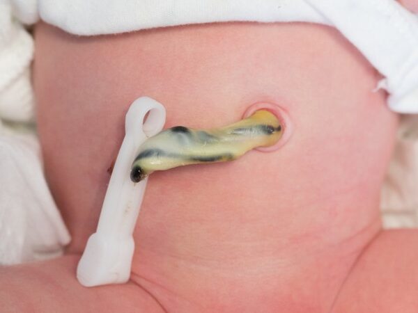 Omega Guard Shaklee Elak Tali Pusat Pendek