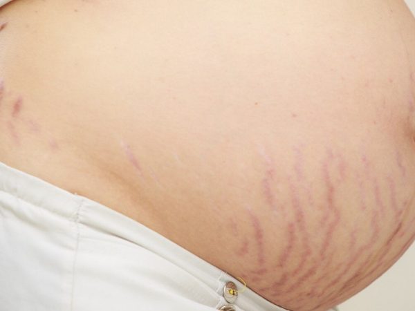 “Stretch Marks” Susah Nak Hilang? ESP & Vit C Shaklee Membantu Kulit Lebih Cantik