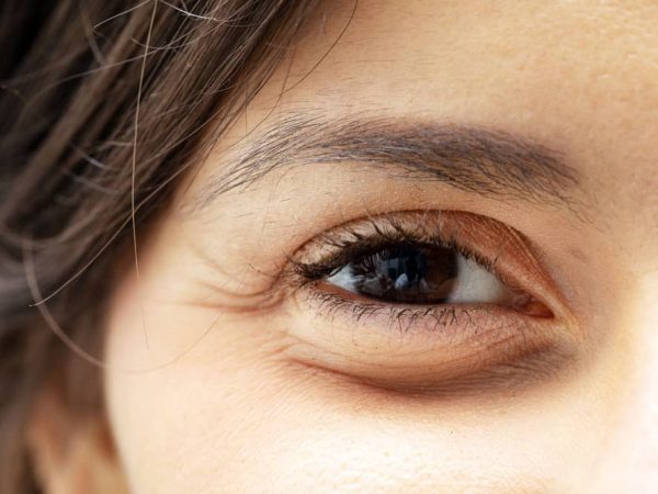 Cara Mudah Hilangkan Eyebag