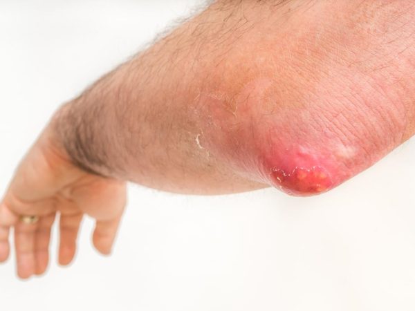 Luka Bisul Lambat Sembuh?