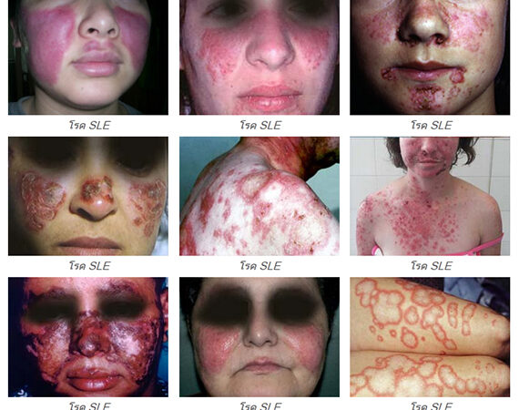 Ubat Tradisional Pesakit SLE