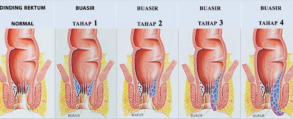 Darah Tinggi Kembali Normal Setelah Mengamalkan Vivix  ?