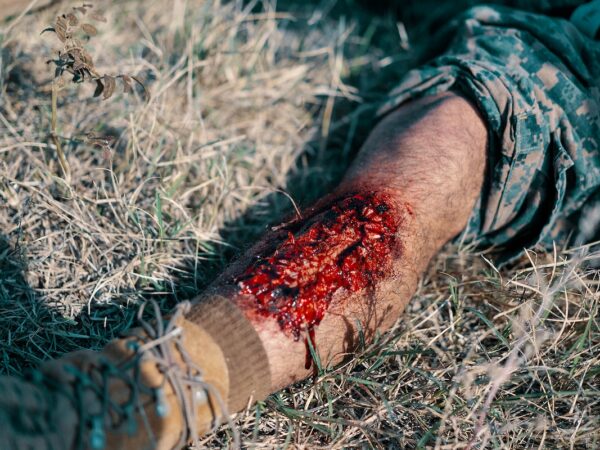 Sembuhkan Luka Kemalangan Dengan Cepat