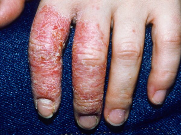 Eczema Gatal berair 2 tahun Hilang Dengan ResV