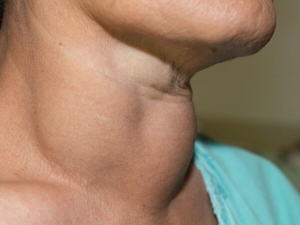 Hormon Tiroid Kembali Normal Dengan Jus Buahan Ini