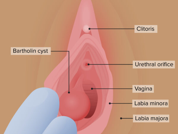 Bartholin Cyst Berjaya Kecut Dengan Vivix