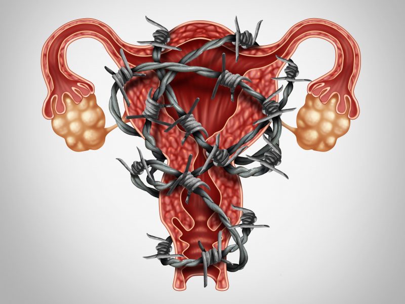 Endometriosis Ganggu Saluran Pembiakan Wanita