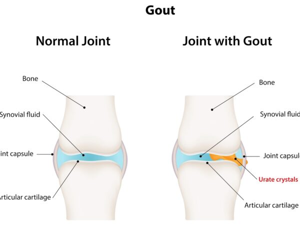 Gout Hilang 3 Hari ?
