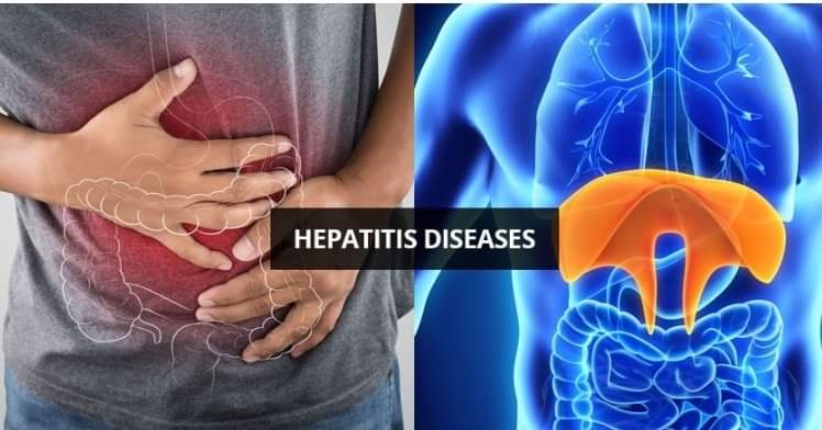 Hepatitis Penyakit Keradangan Hati