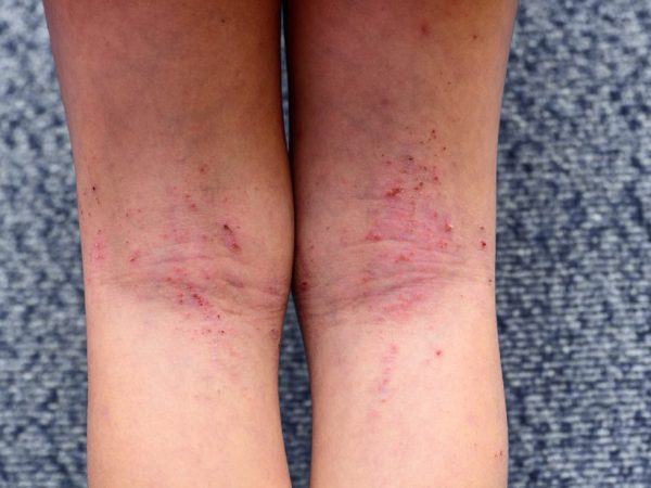 Supplement Ekzema Kulit Dah Tak kering Berkerak