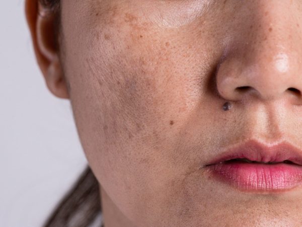 Vitamin Hilangkan Jeragat