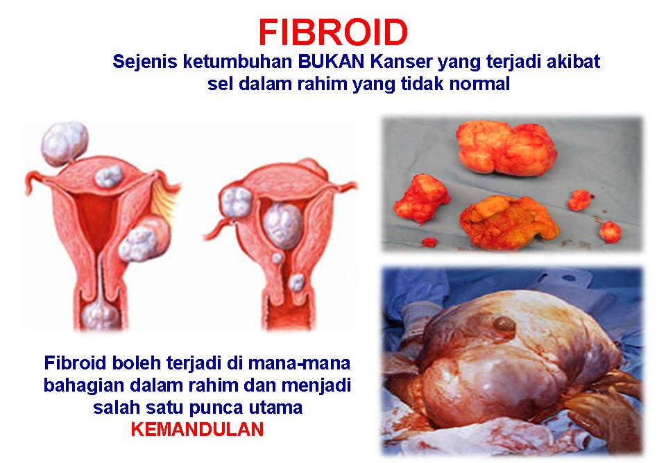 Fibroid 13cm Kecut Tanpa Pembedahan 