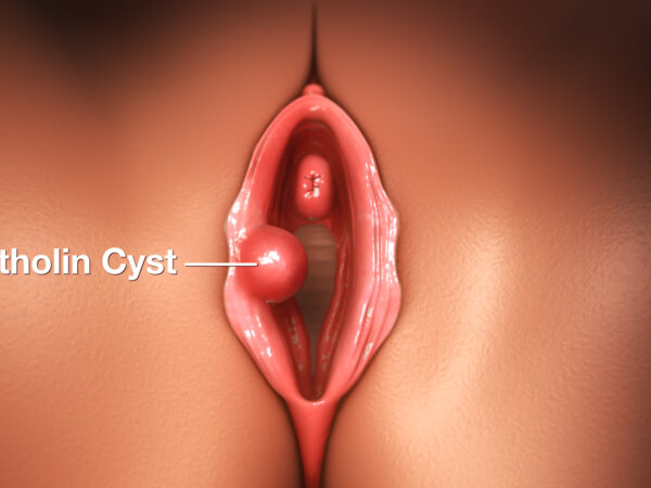 Cara Kecutkan Bartholin Cyst Tanpa Bedah