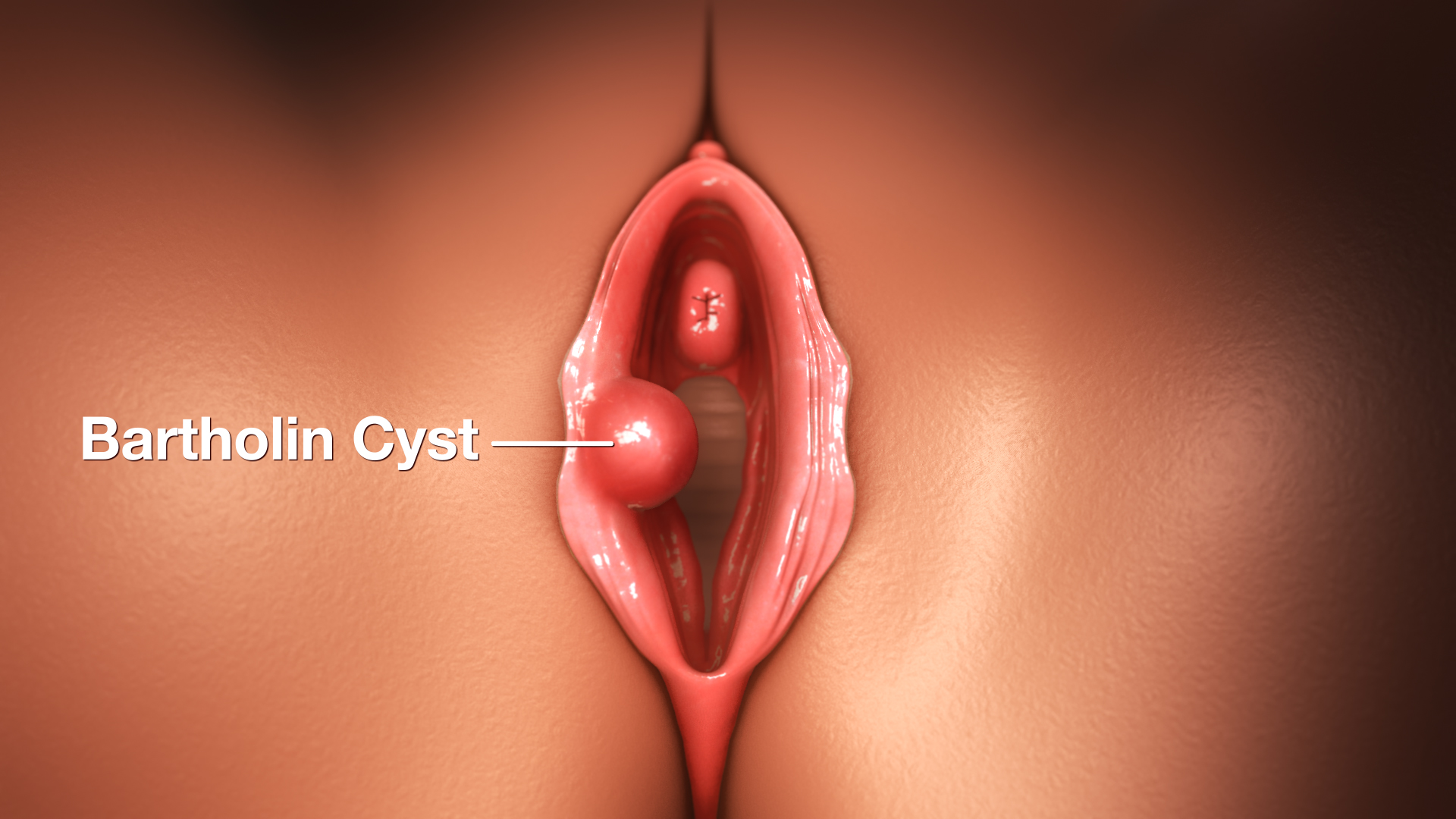 Cara Kecutkan Bartholin Cyst Tanpa Bedah