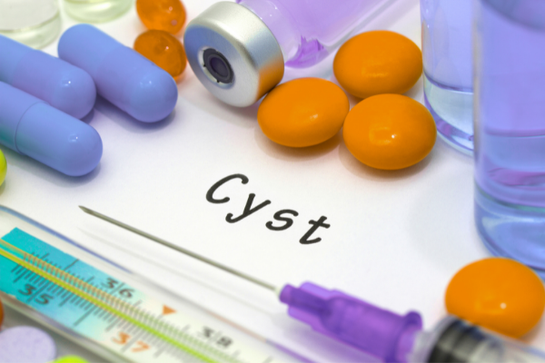 Ubat Untuk Hilangkan Cyst