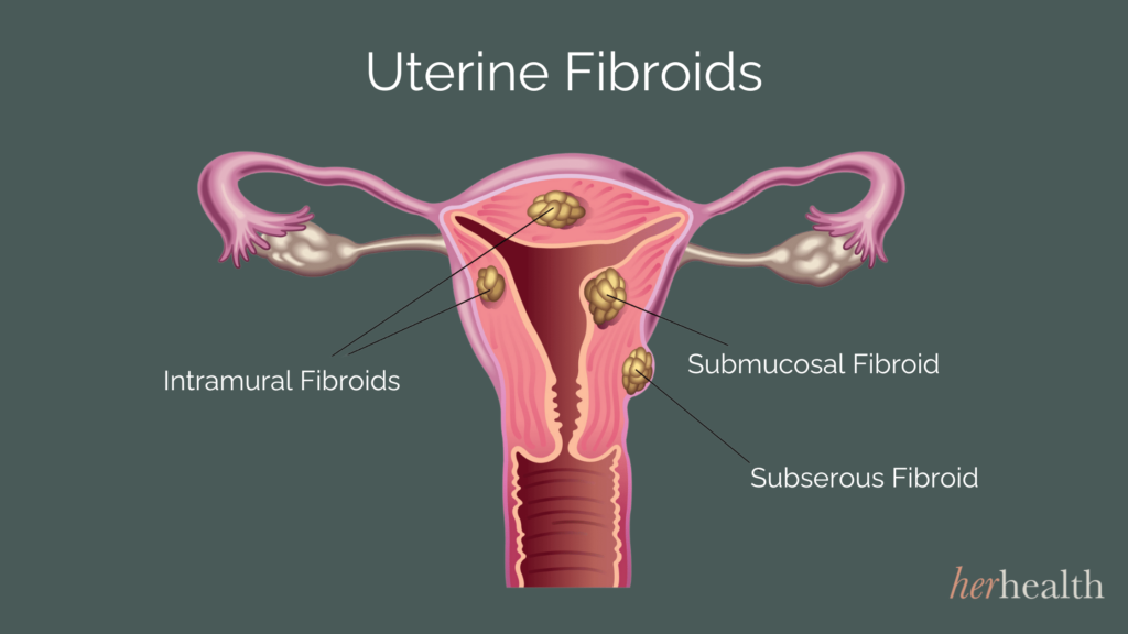 Produk Shaklee Untuk Fibroid