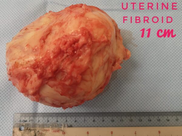 Ubat Kecutkan Fibroid