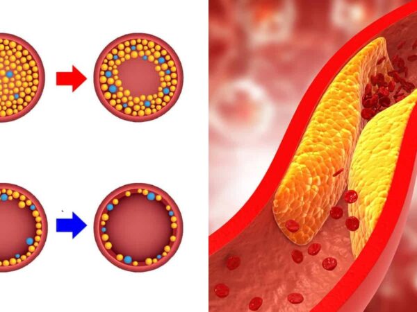 Suplemen Bantu Turunkan Kolesterol Tinggi