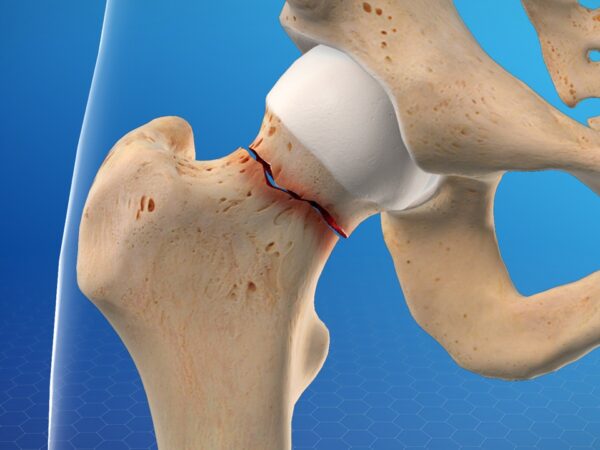 Cara Tulang Retak Cepat Sembuh