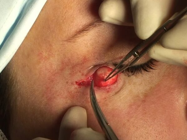 Cara Cyst Hilang Dengan Sendiri