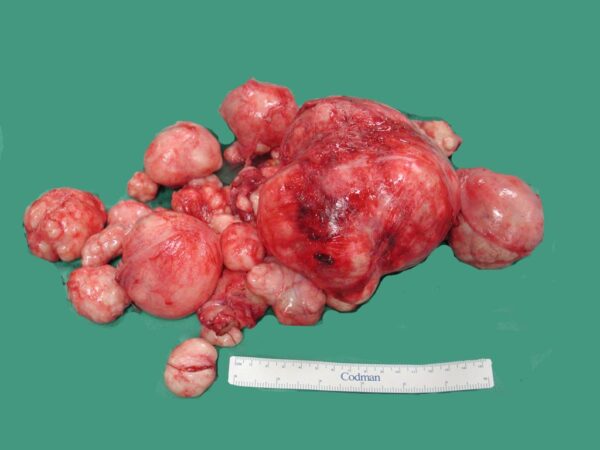 Tanda Fibroid Dalam Perut