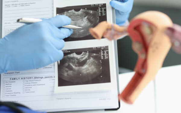Polifenol Kecutkan Cyst?
