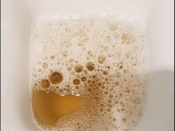 Cara Atasi Kencing Berbuih Dengan Minuman Ini