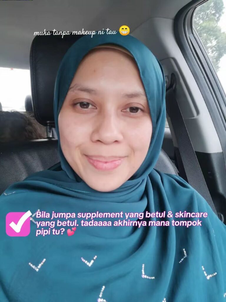 Muka Menggelupas Kering 