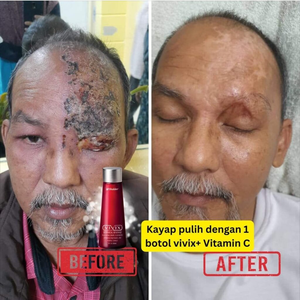 Rawatan Herpes Dengan Supplement
