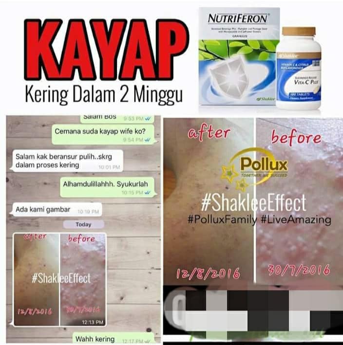 Rawatan Herpes Dengan Supplement