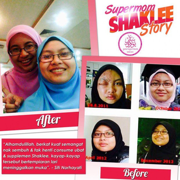 Rawatan Herpes Dengan Supplement