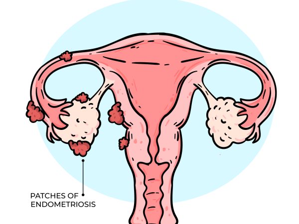 Vivix Shaklee Untuk Endometriosis