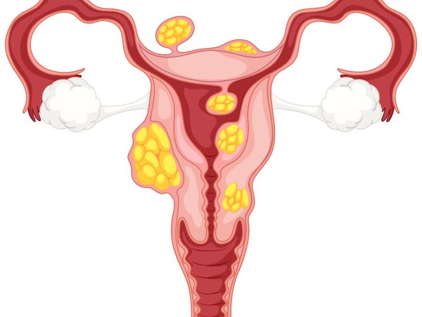 Ubat Cyst Ovari Tanpa Pembedahan