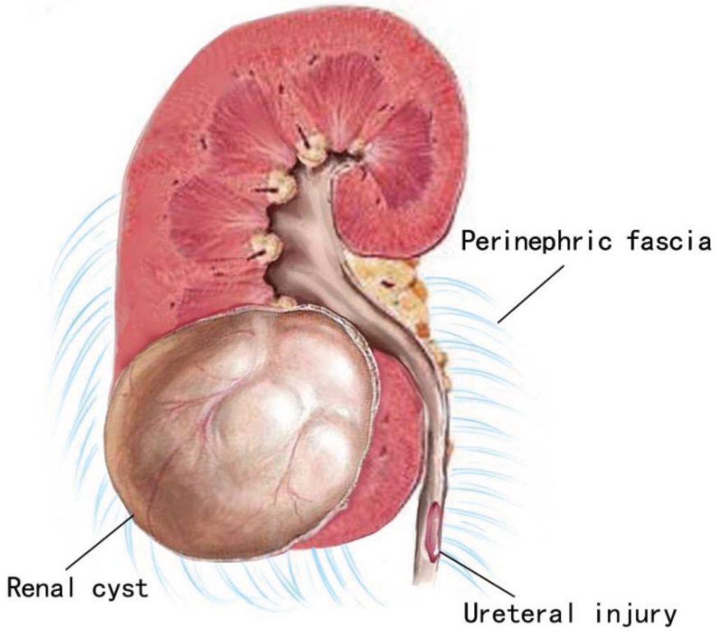 Jenis Cyst Pada Wanita