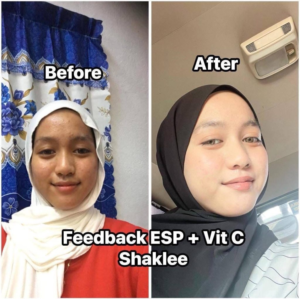 Kulit Jerawat Anak Remaja