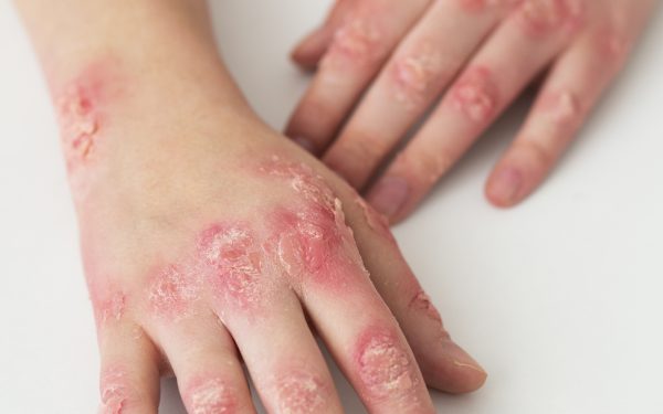 Supplement Untuk Eczema: Cara Kurangkan Gatal & Radang Secara Semulajadi