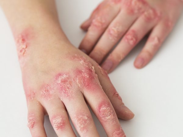 Supplement Untuk Eczema: Cara Kurangkan Gatal & Radang Secara Semulajadi