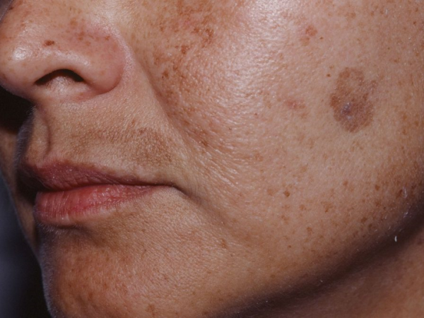 Hilangkan Jeragat Dengan Cepat: Cara Berkesan Untuk Pudarkan Tompok Hitam Di Muka