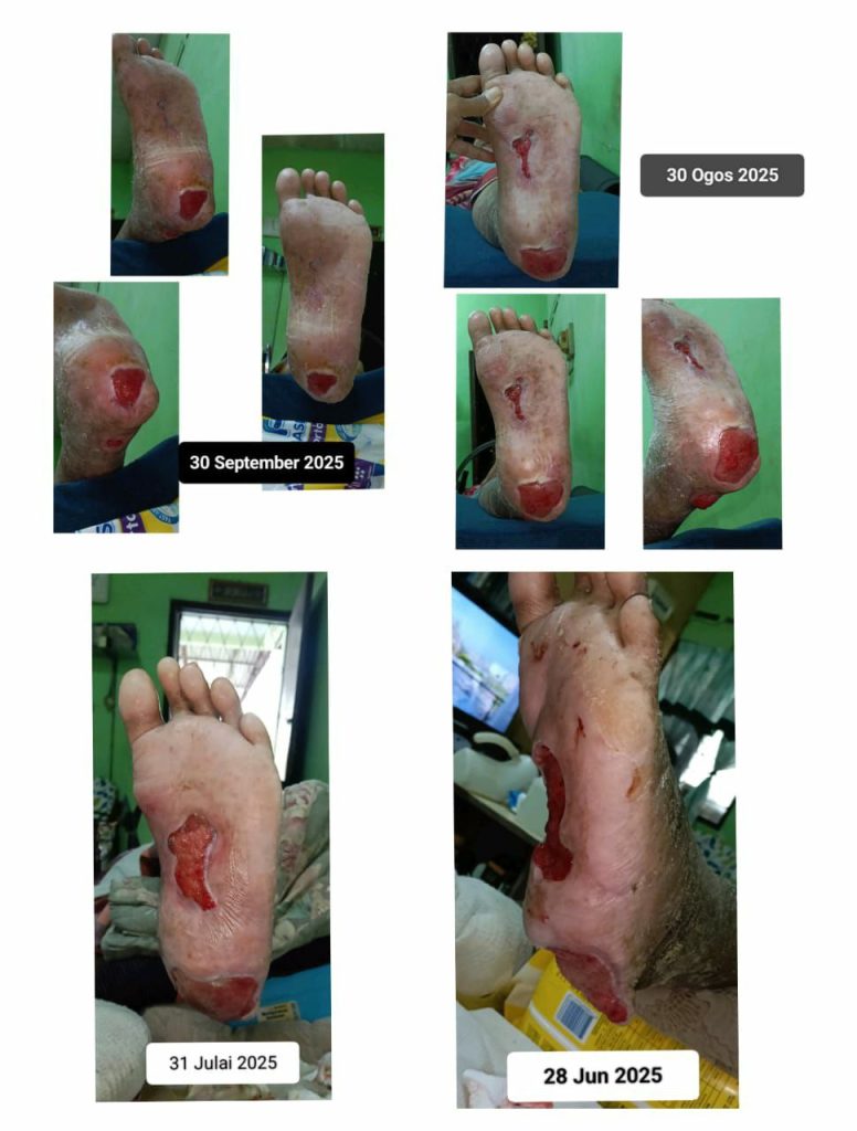 Suplemen Luka Lambat Sembuh