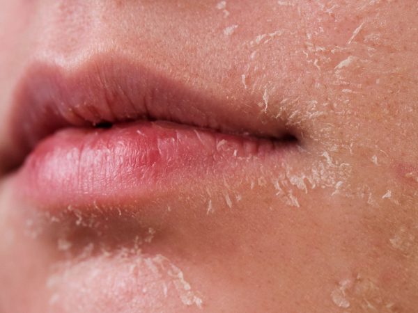 Cara Atasi Kulit Kering di Wajah Dengan Berkesan & Selamat