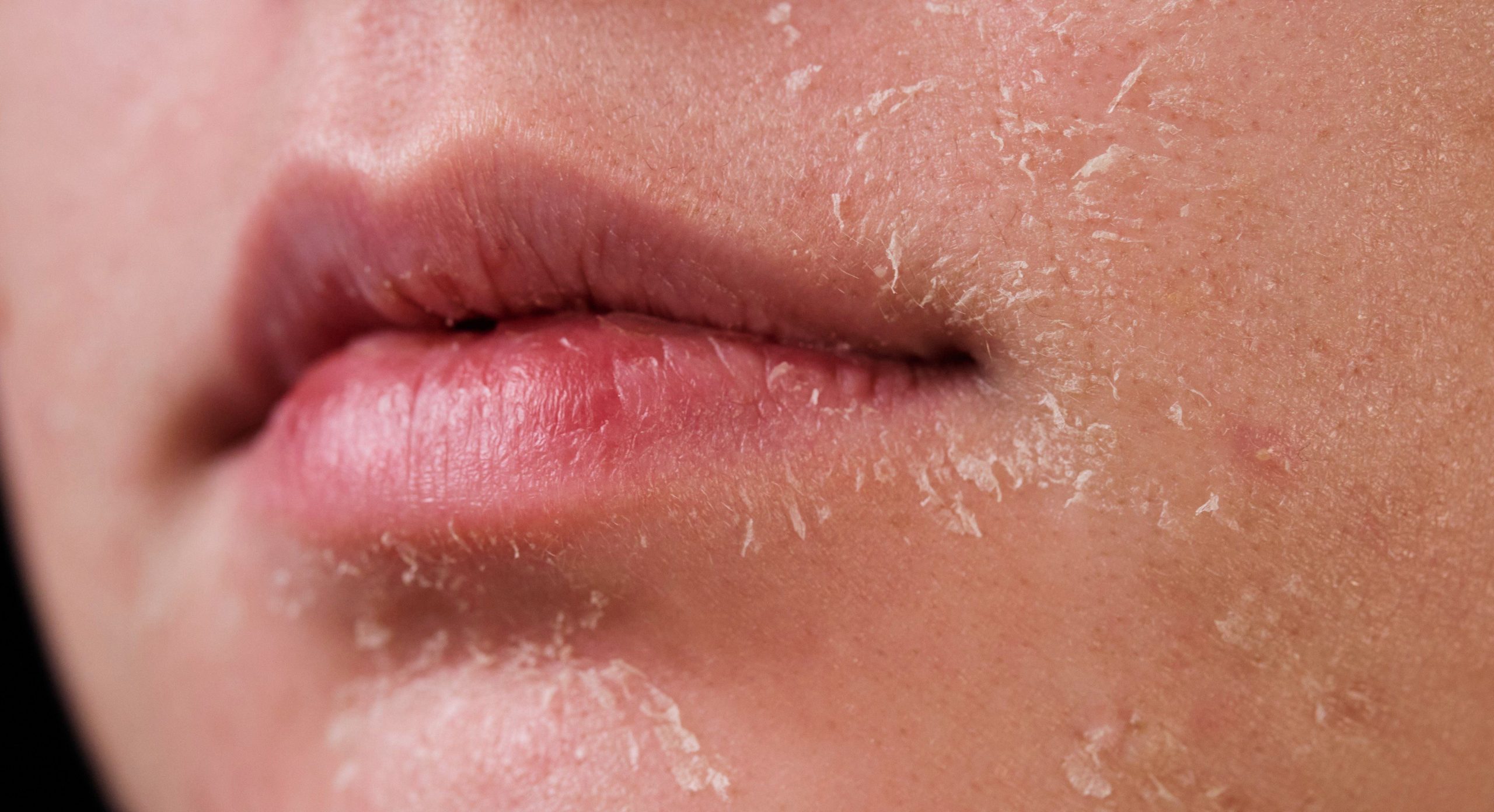 Cara Atasi Kulit Kering di Wajah Dengan Berkesan & Selamat