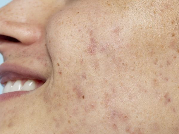 Kulit Berjerawat Tak Hilang