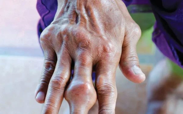 Asid Urik Tinggi: Punca, Simptom dan Cara Turunkan Secara Semula Jadi