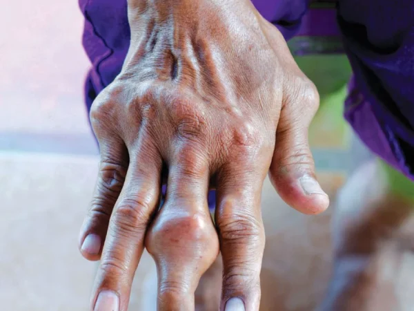 Asid Urik Tinggi: Punca, Simptom dan Cara Turunkan Secara Semula Jadi