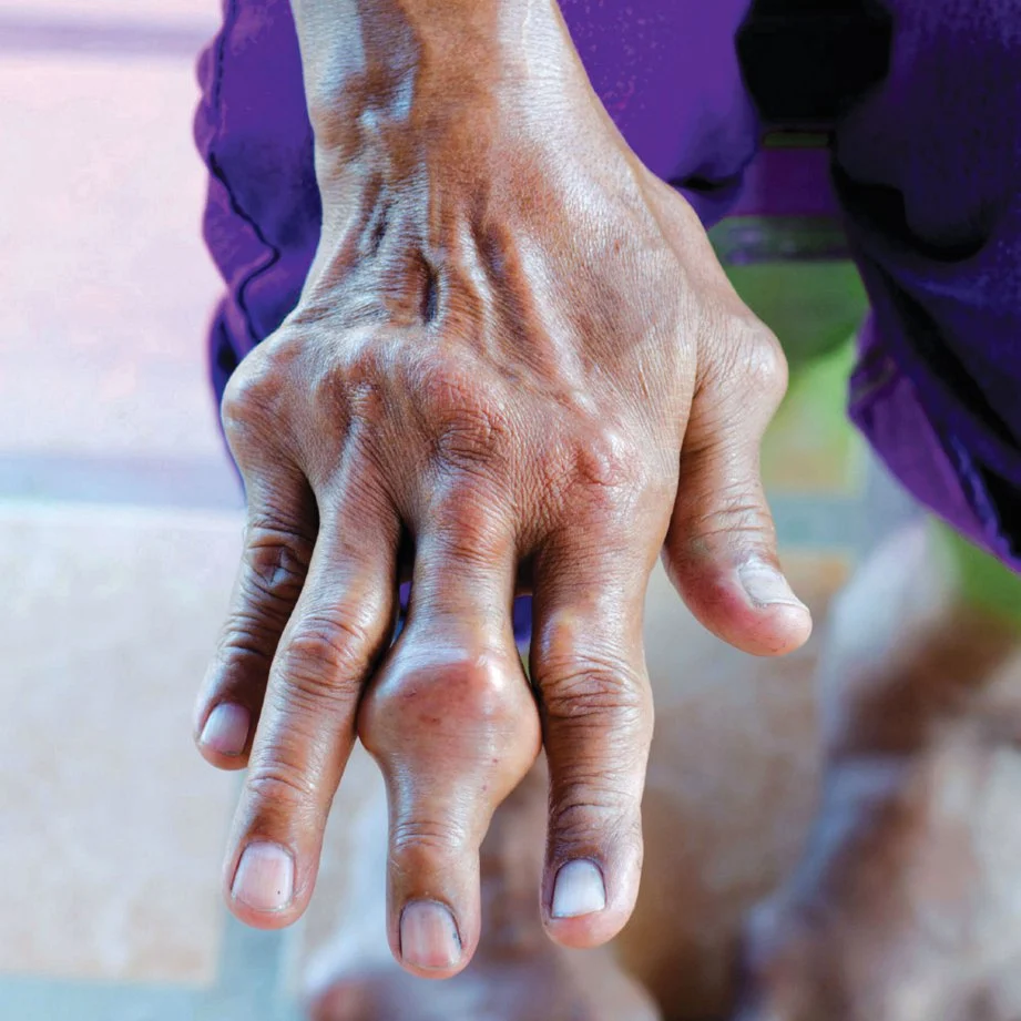 Asid Urik Tinggi: Punca, Simptom dan Cara Turunkan Secara Semula Jadi