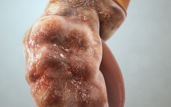 Tanda Awal Buah Pinggang Bermasalah: Jangan Tunggu Sampai Terlambat!