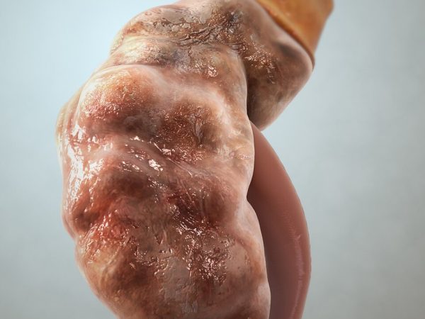 Tanda Awal Buah Pinggang Bermasalah: Jangan Tunggu Sampai Terlambat!